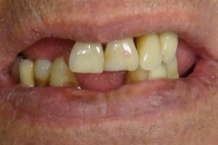 Implantaciya+metallokeramika-01