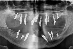Implantaciya+metallokeramika-02