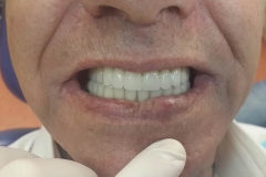 Implantaciya+metallokeramika-04