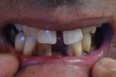 Implantaciya+metallokeramika-01