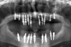 Implantaciya+metallokeramika-02