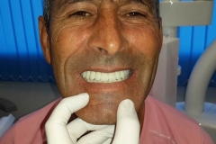Implantaciya+metallokeramika-03