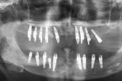 Implantaciya+metallokeramika-01
