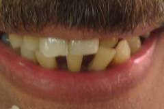 Implantaciya+metallokeramika-02