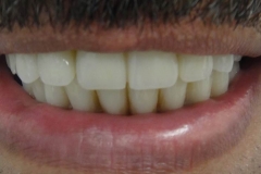 Implantaciya+metallokeramika-03