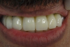 Implantaciya+metallokeramika-04