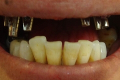 Implantaciya+metallokeramika-01