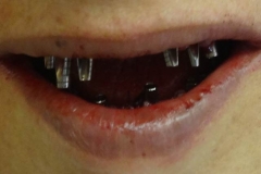 Implantaciya+metallokeramika-02