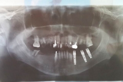 Implantaciya+metallokeramika-01