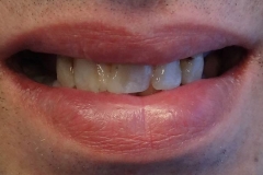 Implantaciya+metallokeramika-02