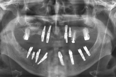 Implantaciya+metallokeramika-03