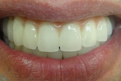 Implantaciya+metallokeramika-04