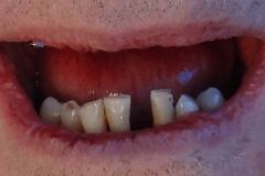 Implantaciya+metallokeramika-01