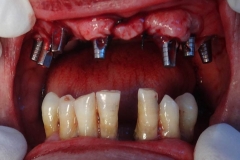 Implantaciya+metallokeramika-02