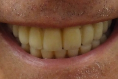 Implantaciya+metallokeramika-03
